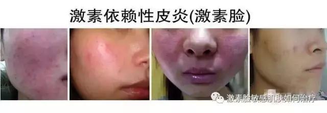 激素脸的症状图片展现,激素脸有哪些症状如何辨认