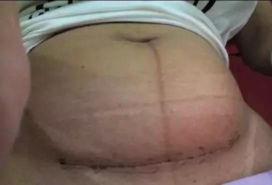 双胞胎产妇后续,孩子五周剖腹产伤口发臭流脓