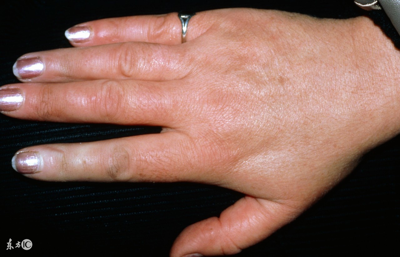 冬天长冻疮又疼又痒该怎么办,冬天长冻疮的最佳治疗方法