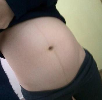 双胞胎产妇后续,孩子五周剖腹产伤口发臭流脓