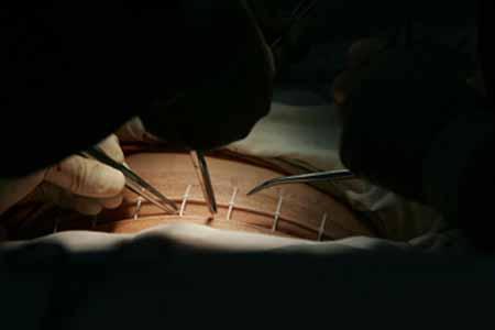 剖腹产后伤口用什么药不易留疤,剖腹产后刀疤为什么会发炎