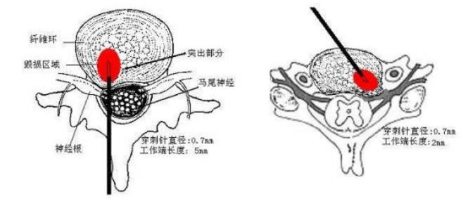 腰突什么情况就不能做微创了,腰突所谓的治愈就是症状消失吗