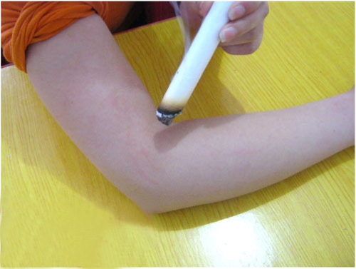 艾灸治疗肩周炎最好的方法,艾灸治疗肩周炎穴位图