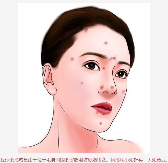 脸上的丘疹脓包是什么细菌,脸上的痘痘多是什么原因