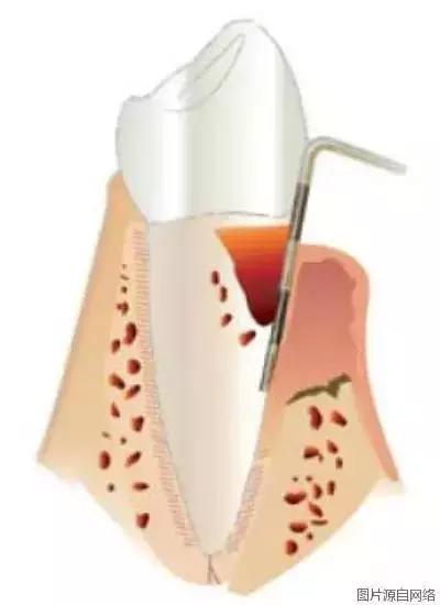 掉牙时强行拔牙弄下来会发生什么,拔牙以后真的会牙齿掉得快吗