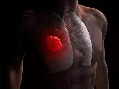 新上市的治疗非小细胞肺癌的药 (香港最新治疗肺癌的药物)