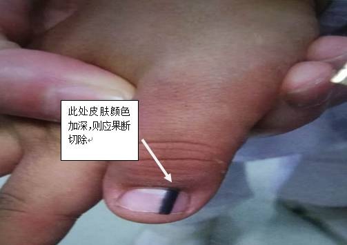 身上的黑痣什么情况下要去检查,身上的黑痣要不要去除