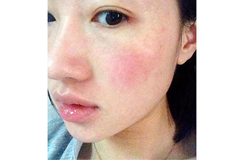 皮肤过敏不用药能自行恢复吗,脸部过敏灼伤怎样恢复正常皮肤