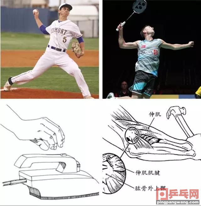 网球肘的治疗特效方法有吗,网球肘如何预防和治疗