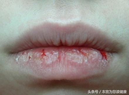 口干舌燥是什么原因怎么解决,口干舌燥一般是什么原因引起的