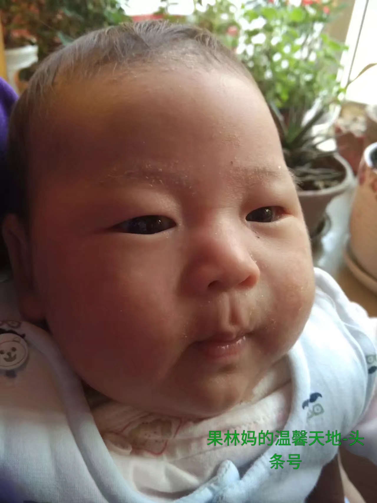 宝宝得了湿疹可以打疫苗吗,得了湿疹有什么症状