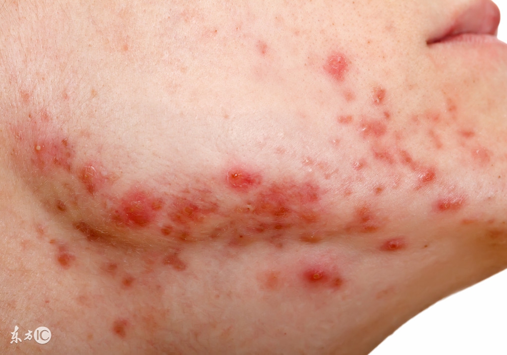 暗疮怎么回事,暗疮发病的原因