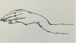 各类四肢骨折的常见病因,骨折体征知识点记忆口诀