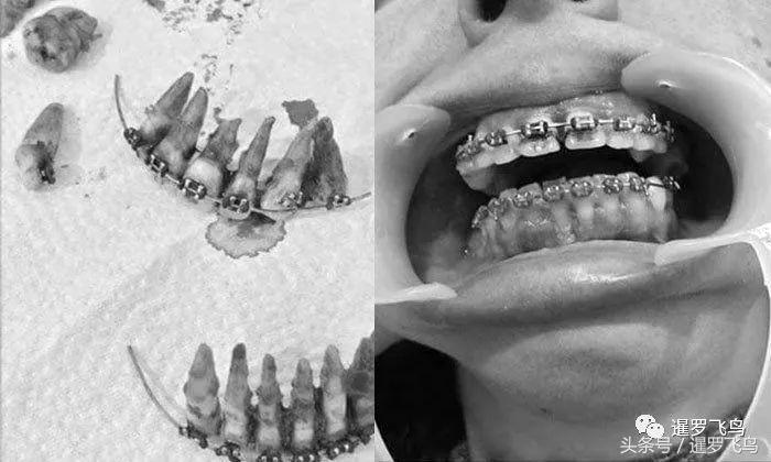 爱美戴牙套导致整排牙齿脱落！看着都疼！泰国医生发文警示