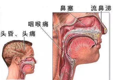 鼻炎漫画视频,过敏性鼻炎科普小视频漫画