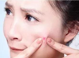 如何改善孩子的痘痘肌,怎么做抵抗痘痘