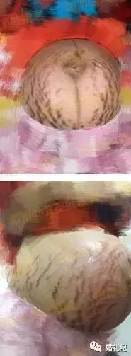霍思燕怀孕抹什么油防止妊娠纹,霍思燕的妊娠纹怎么样去掉的