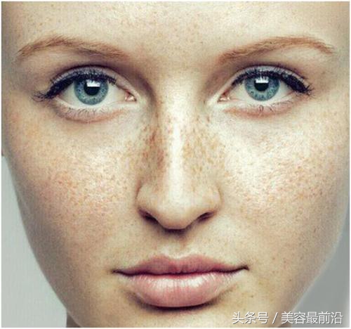 去掉脸上麻雀斑的方法,如何去掉脸上的雀斑呢