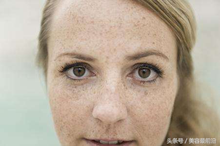 去掉脸上麻雀斑的方法,如何去掉脸上的雀斑呢