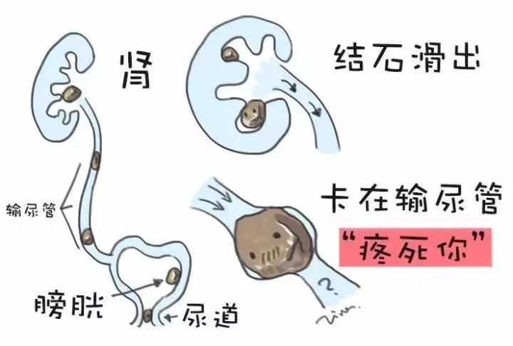 对尿结石有帮助的产品,尿路结石神器