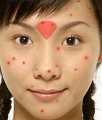 女性外面长了小痘,外面长什么痘里面就有什么病