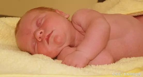 u型脐带压迹应注意啥,脐带边缘性附着需要注意什么