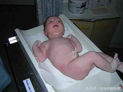 u型脐带压迹应注意啥,脐带边缘性附着需要注意什么