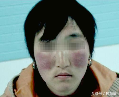 脸蛋红是心室病的征兆,心室导致脸发红的症状