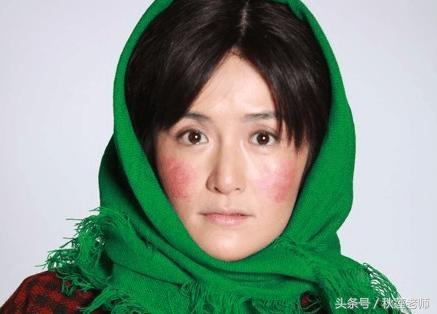 红血丝用激光能去掉吗,红血丝可以用激光去掉吗