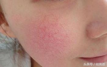 脸蛋红是心室病的征兆,心室导致脸发红的症状