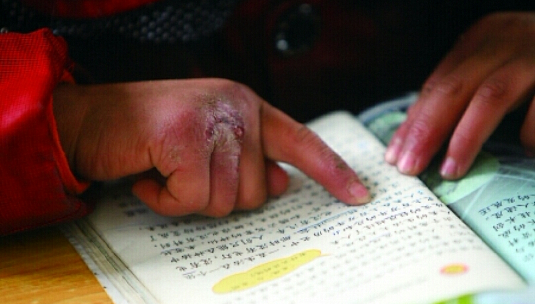 冻伤疮什么意思,冻疮的治疗方法