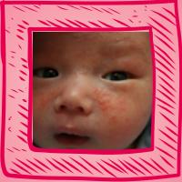 湿疹的相关介绍,湿疹的病因及临床表现转载