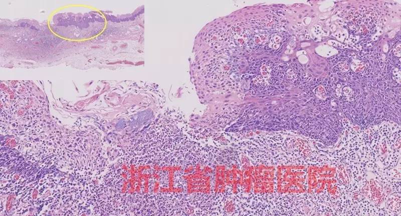 食管大面积黏膜病变，看看这家医院如何处理？！