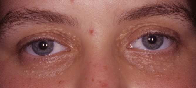 海蓝之谜眼霜脂肪粒,白云山眼霜去脂肪粒