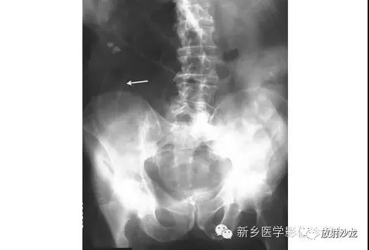 详细腹部平片解剖+正常表现+读片技巧+病例分析