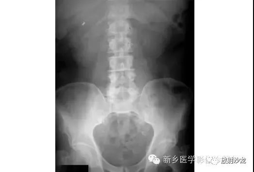 详细腹部平片解剖+正常表现+读片技巧+病例分析