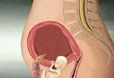 宫内孕不等于宫外孕？一字相差害人命！