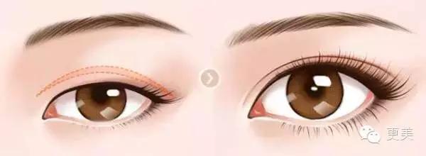 抬头纹手术会不会影响眼睛,抬头纹手术后有后遗症吗