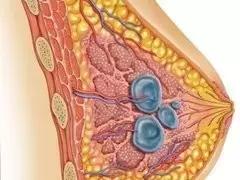 乳腺囊肿三级是什么病严重吗,乳腺多发性囊肿怎么治疗最好