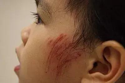 幼儿园常见意外伤害急救处理方法,幼儿园意外伤害的预防及急救