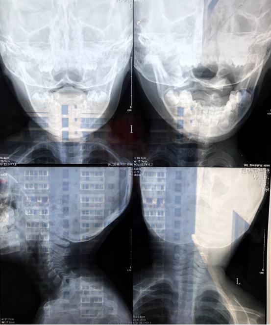 宝宝从床上摔下眼睛肿怎么回事,宝宝从床上摔下来眼睛肿了好大