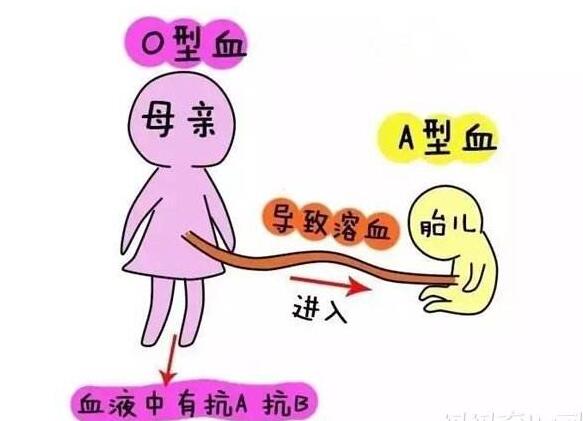 孕妇abo溶血有什么注意的,怀孕溶血是什么血型才会发生的