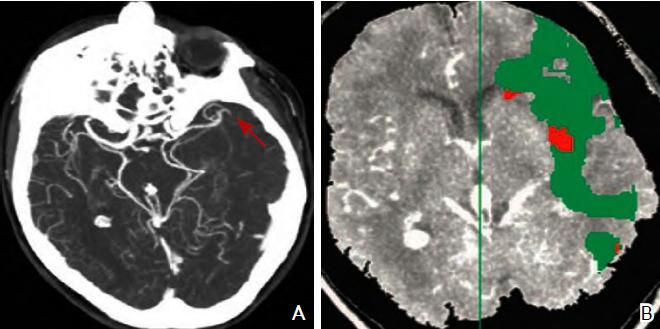 2017急性缺血性卒中血管内治疗影像评估中国专家共识