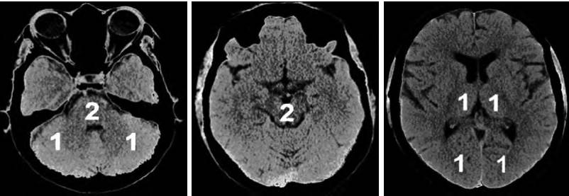 2017急性缺血性卒中血管内治疗影像评估中国专家共识