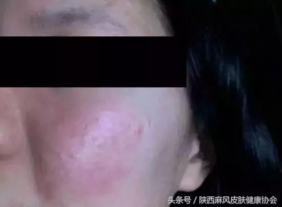 化妆品过敏了化妆品有什么责任,皮肤过敏了以后能用什么化妆品
