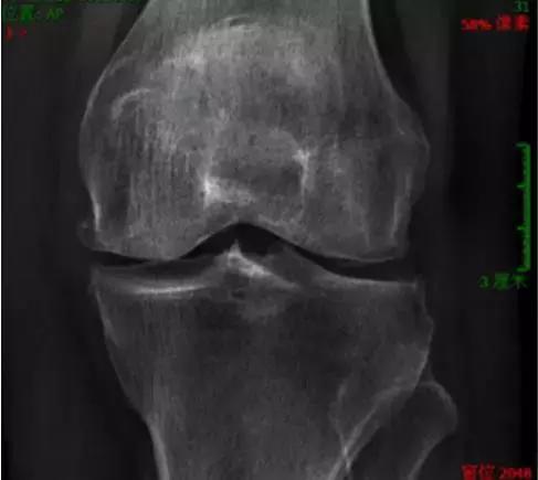 上下楼梯痛的调理方法,上楼梯关节疼怎么治疗