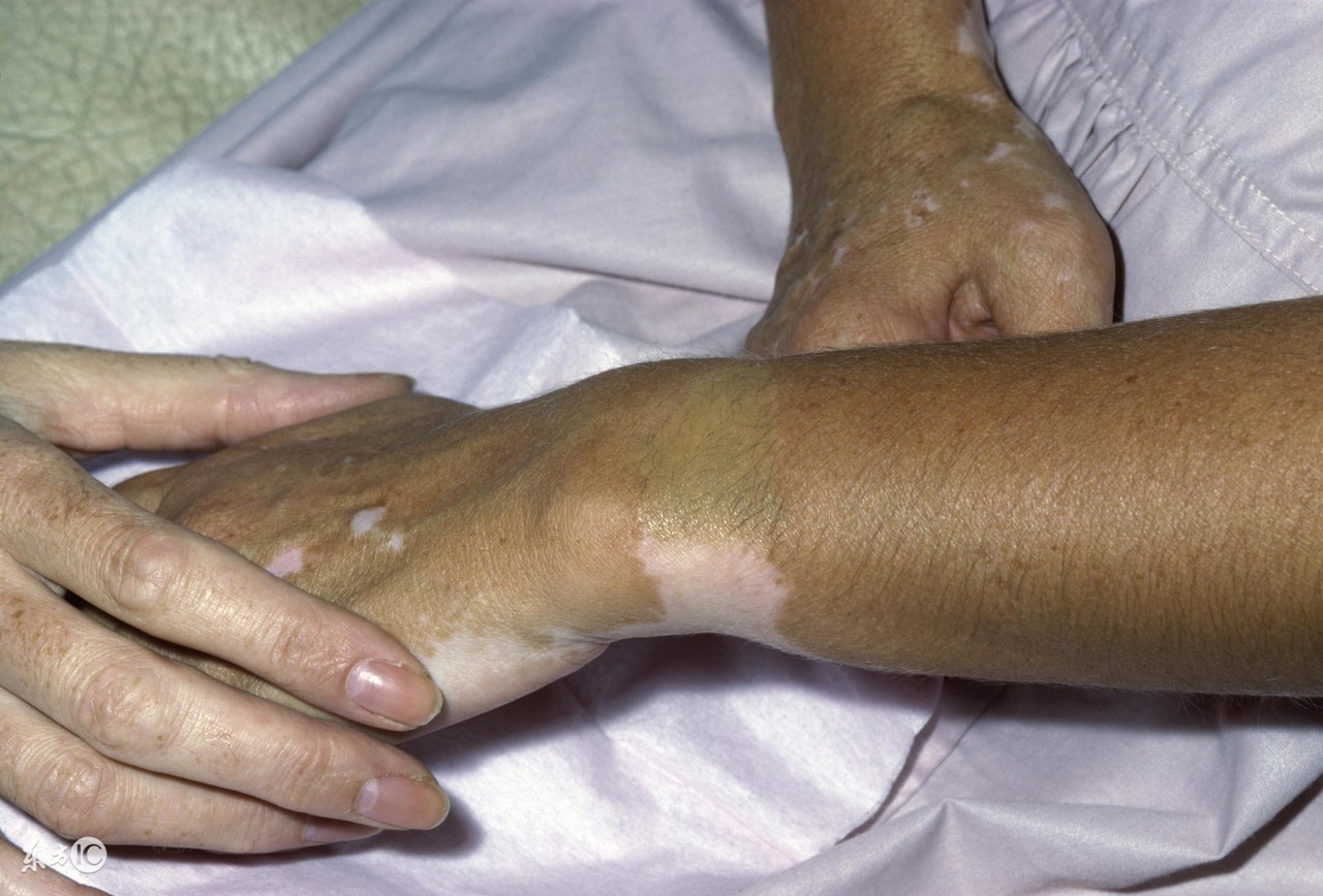 得了白癜风如何防止白斑扩散,白癜风在治疗还扩散怎么办