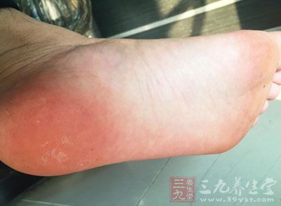 三个治脚气的秘方 (千古名方治脚气方子)