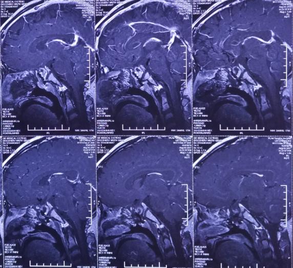 脑膜膨出手术是用什么修补的,蝶鞍区脑膜膨出手术怎么做