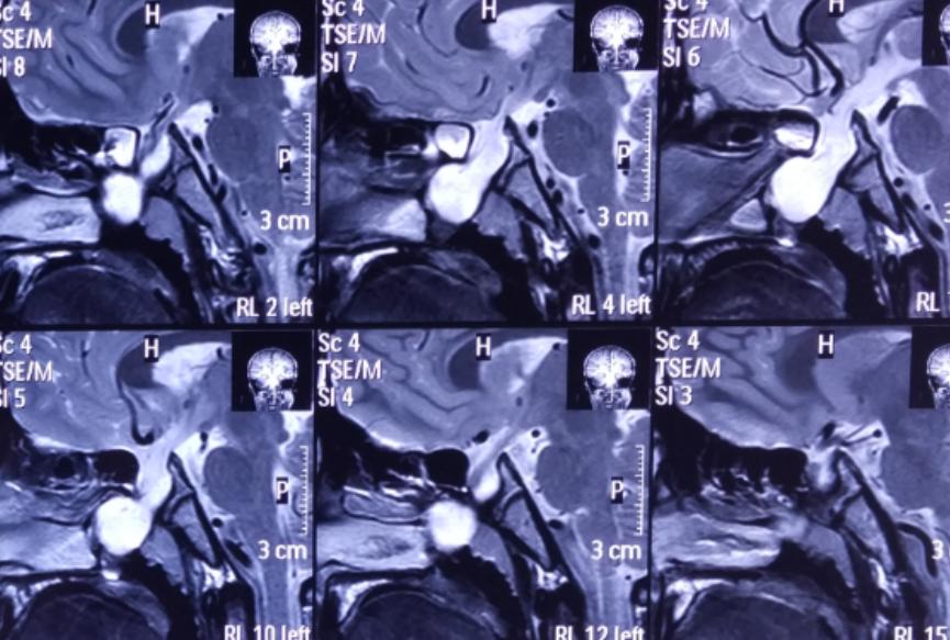 脑膜膨出手术是用什么修补的,蝶鞍区脑膜膨出手术怎么做